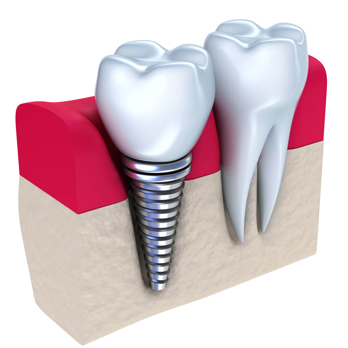 Missing teeth? Learn how dental implants can restore your smile